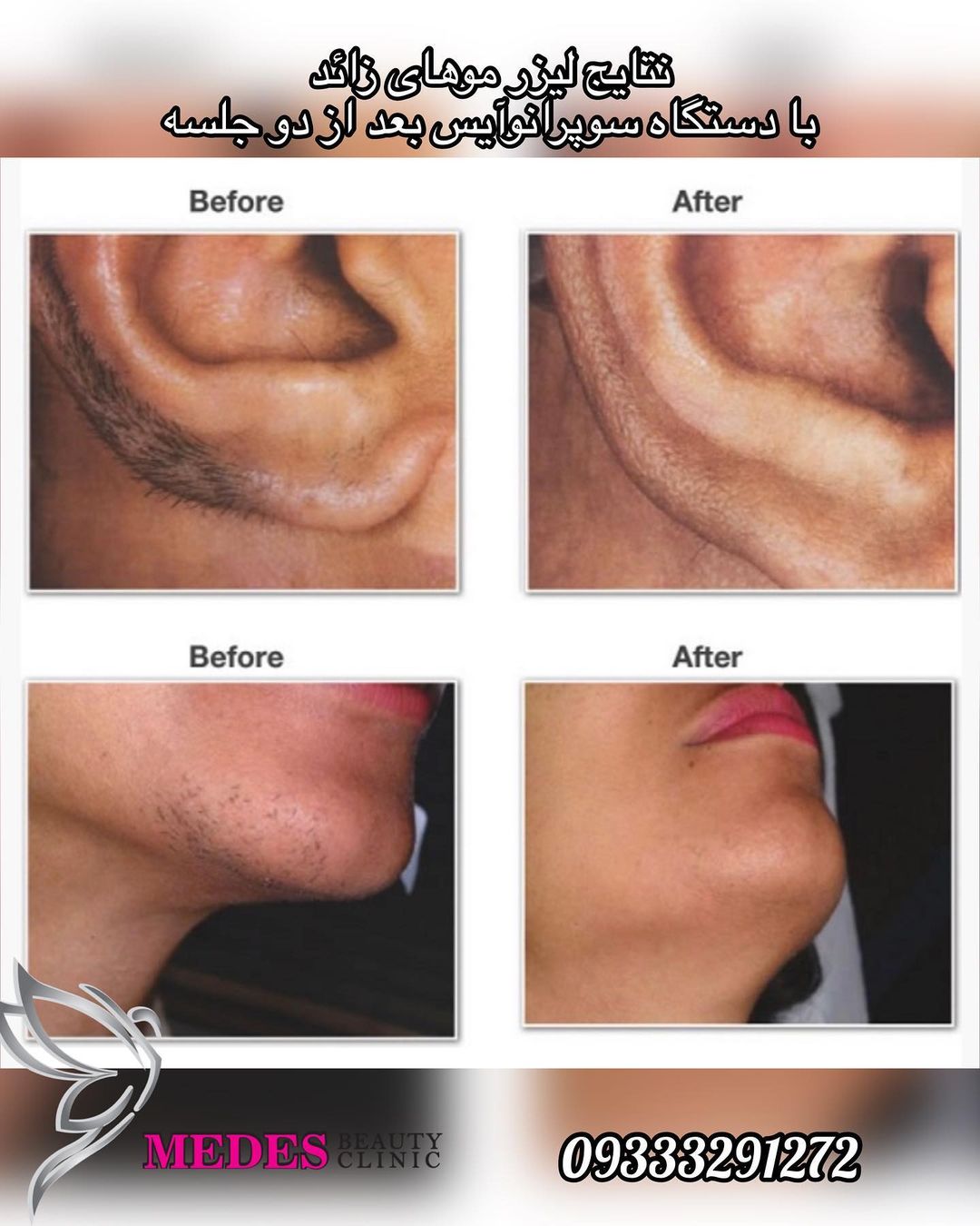 گالری لیزر مو زائد